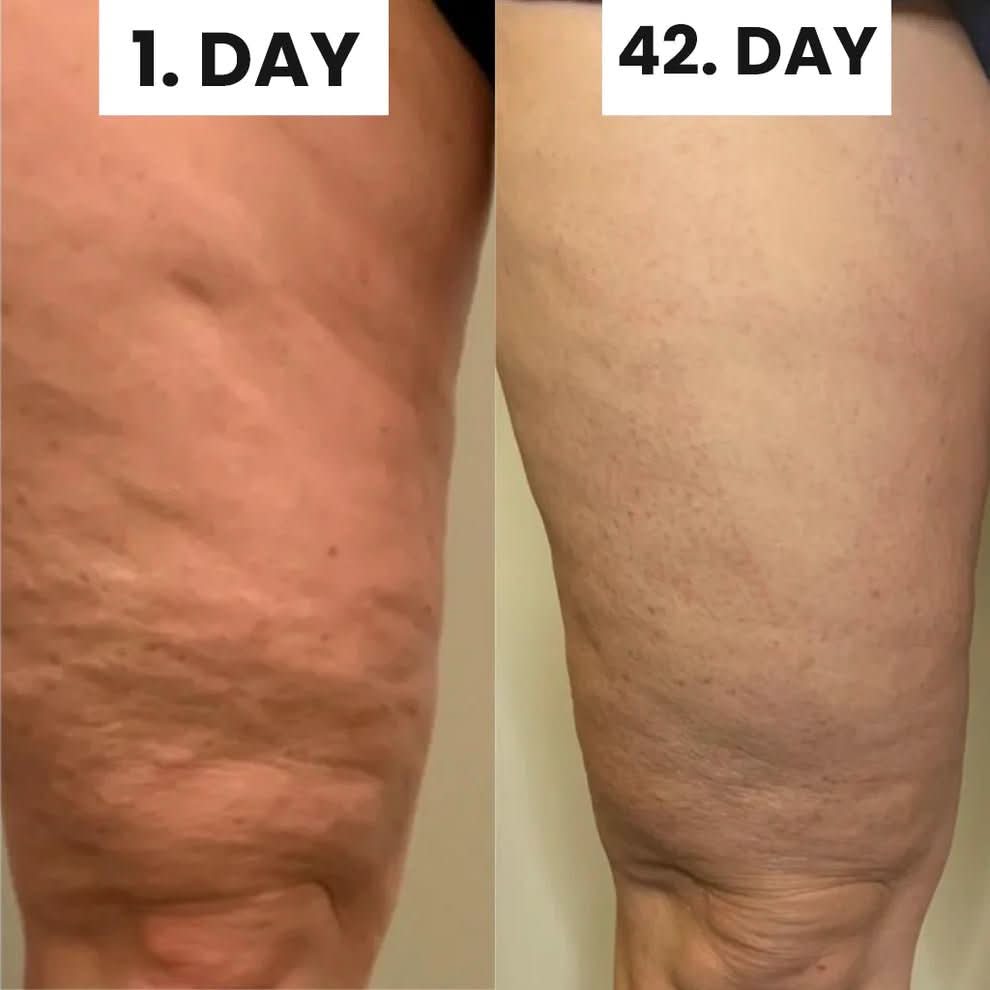 Lunara Cellulite Relief Kit
